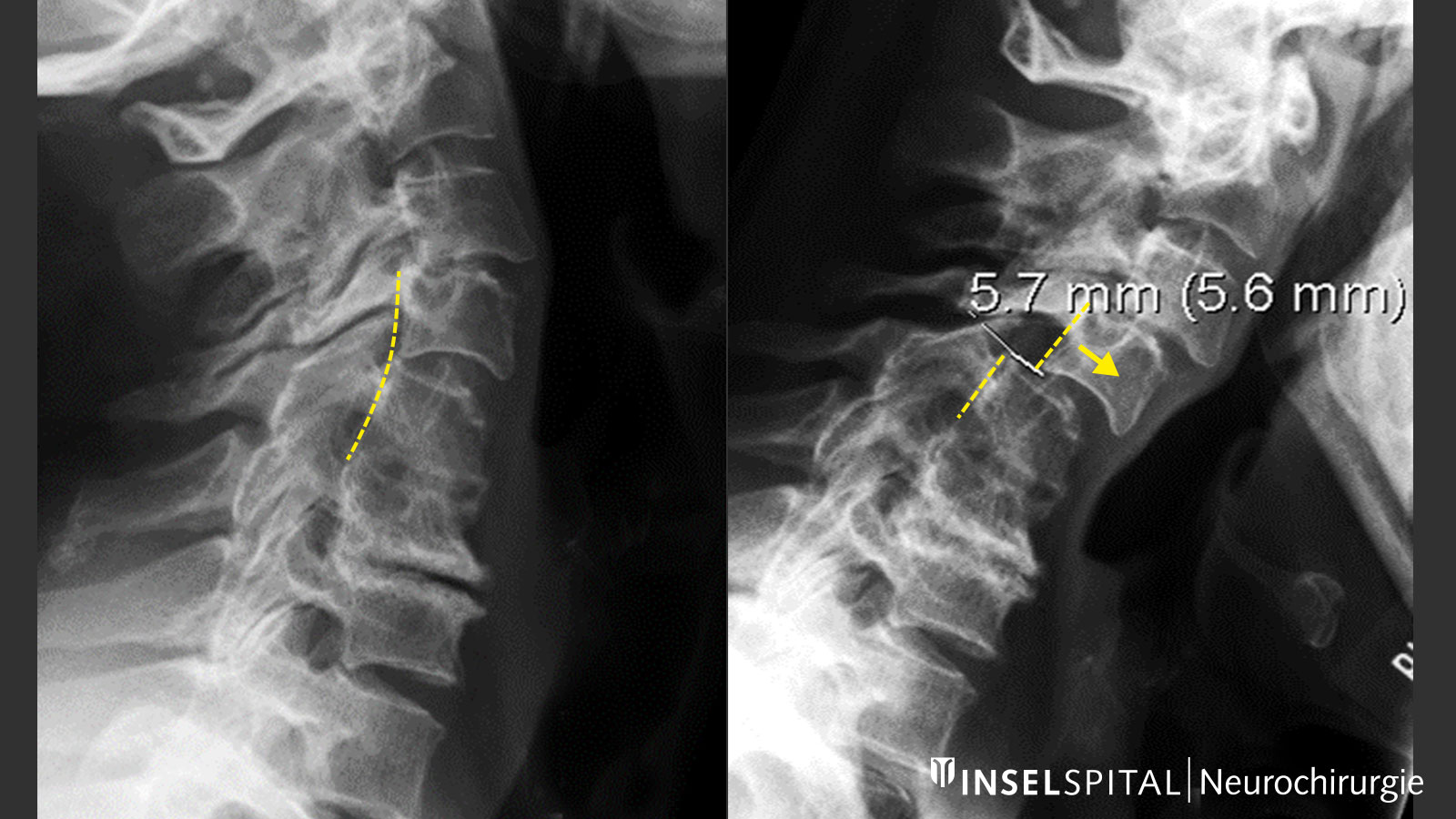 2 x-rays. Left without and right with spondylolisthesis..