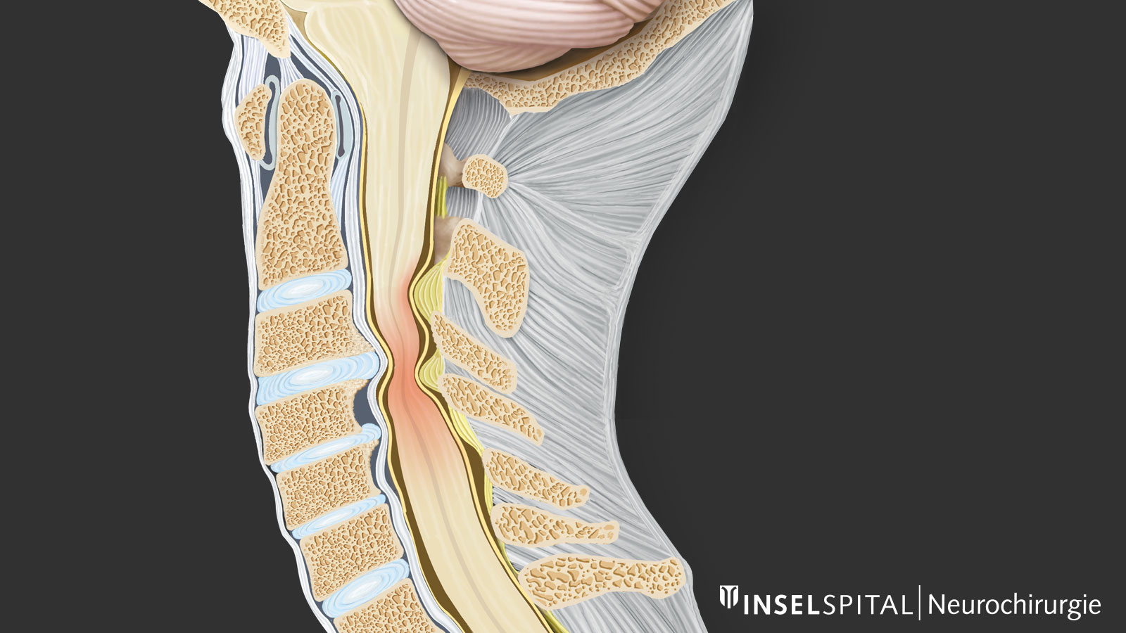 ​Drawing of the cervical spine with narrowed spinal canal and spinal cord compression