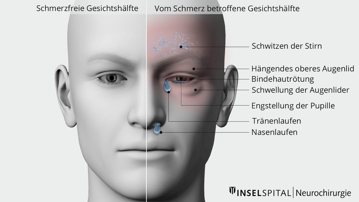 Cluster-Kopfschmerzen | Neurochirurgie Inselspital Bern