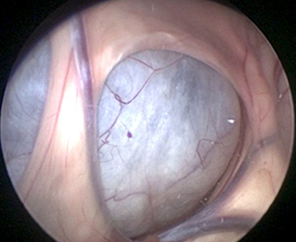View of an arachnoid cyst through the endoscope camera