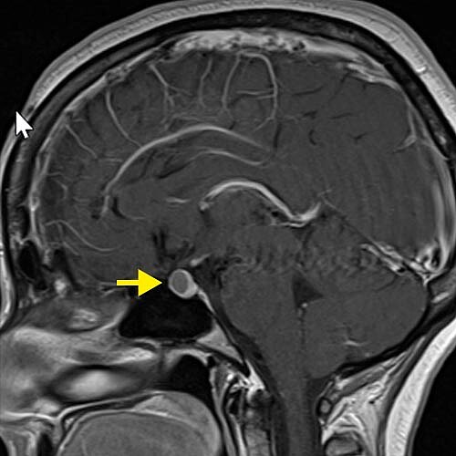 Image IRM avec contraste d'un petit kyste de la fente de Rathke 